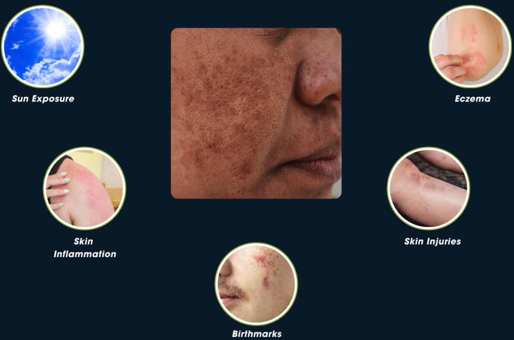 What causes pigmentation?